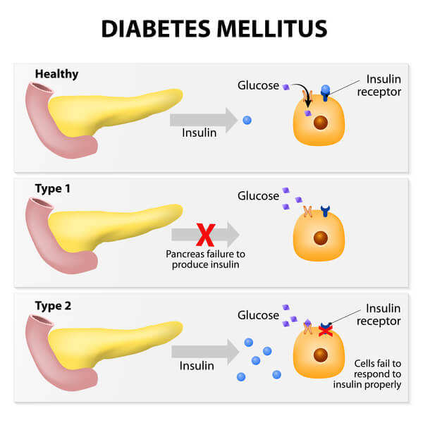 Diabetes Mellitus